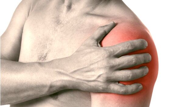 Un hombro hinchado, enrojecido y agrandado síntomas de artrosis de la articulación del hombro grado 2-3