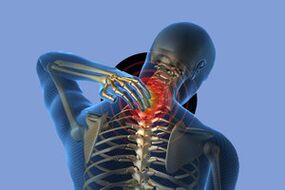 Síntomas de osteocondrosis cervical