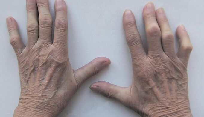dolor en las articulaciones de los dedos
