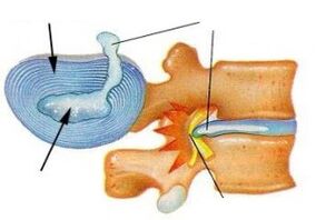 destrucción del anillo fibroso en la osteocondrosis cervical