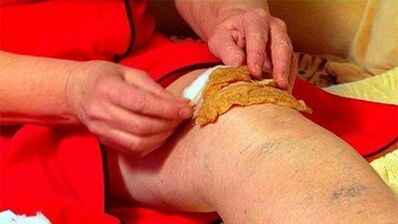 Compresas para la artrosis de la articulación de la rodilla
