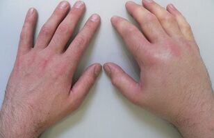 artralgia como causa de dolor en las articulaciones de los dedos