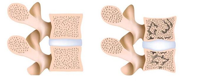 osteoporosis la eliminación de calcio de los huesos