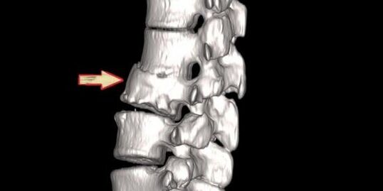 patología espinal como causa de dolor de espalda