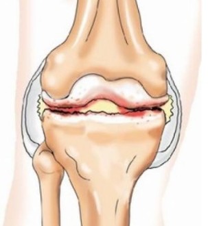 Vospaleniya de los tendones de la rodilla