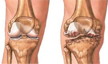 Artrosis de la rodilla