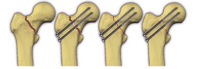 fijación del cuerpo óseo con alfileres para el dolor en la articulación de la cadera