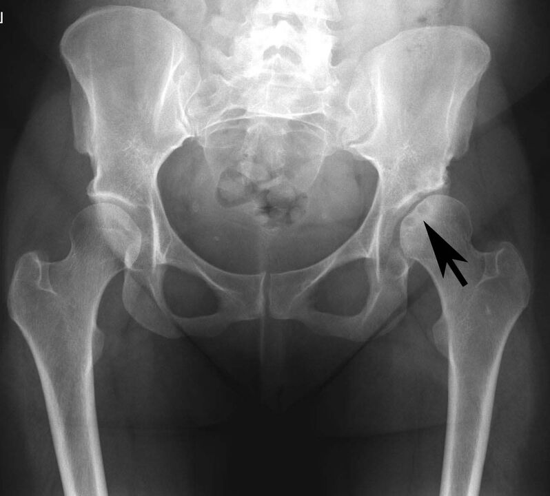 Deposición de sales de calcio en la articulación de la cadera con pseudogota en la radiografía