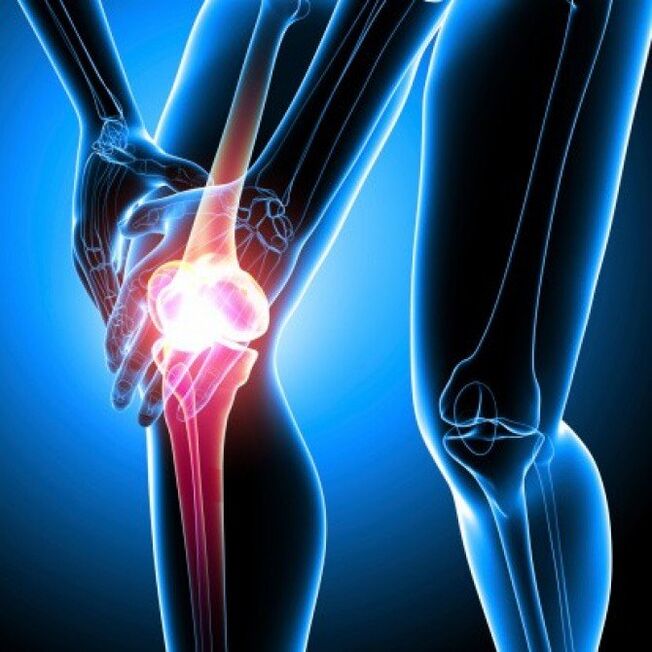 La artritis reumatoide en etapa avanzada puede causar dolor en la cadera