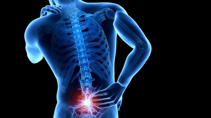 dolor de espalda con osteocondrosis lumbar