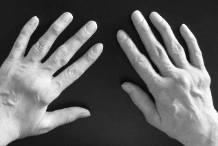 la enfermedad de manos